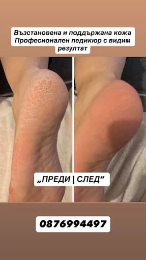 Медицински педикюр - преди и след